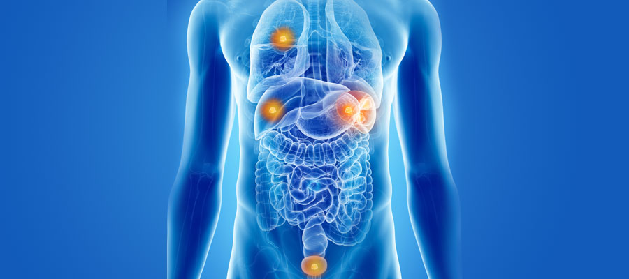 multi tumors illustration